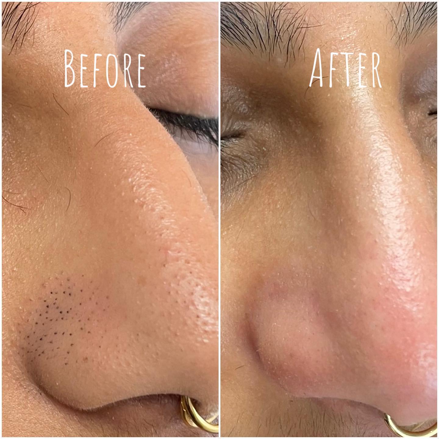 Before and after of a blackhead extraction facial along the side of the nose.